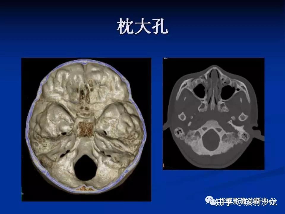 实用、详细的颅底各孔道影像解剖! - 知乎