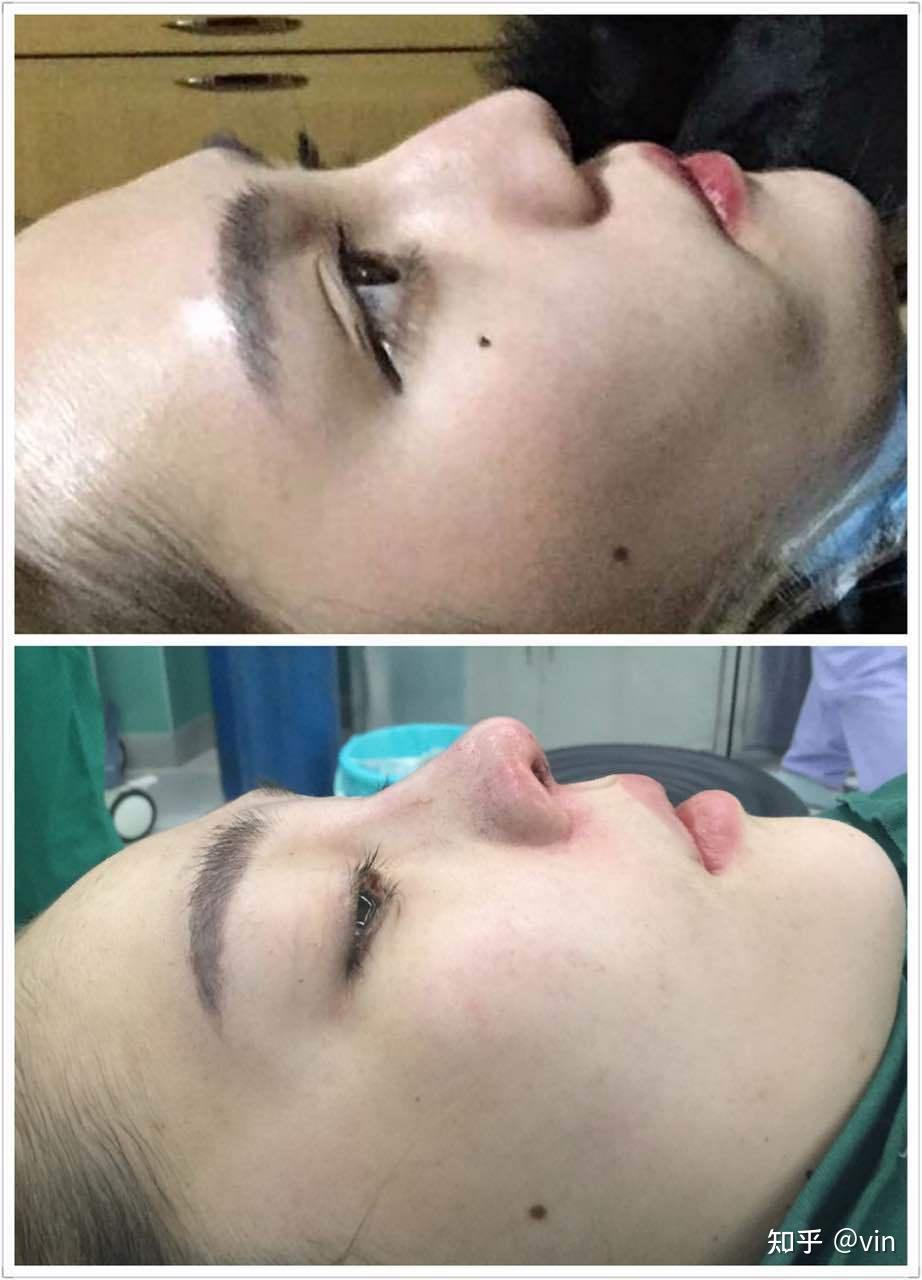 玻尿酸隆鼻你需要了解的问题