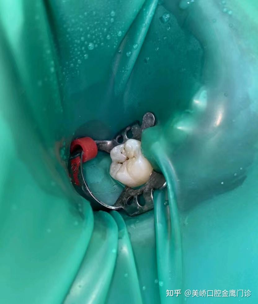 橡皮障——小身板大作用的牙科诊室必备物品! - 知乎