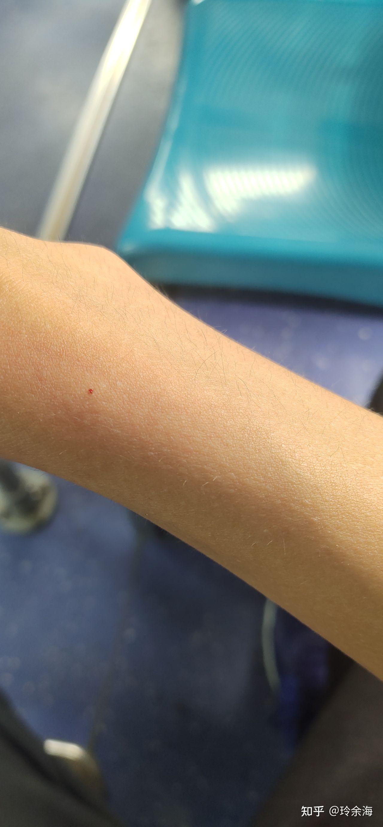 被七星瓢虫咬了会怎么样