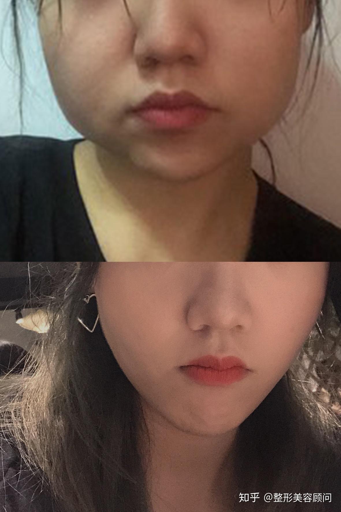 咬肌大跟什么有关系怎样可以使咬肌变小