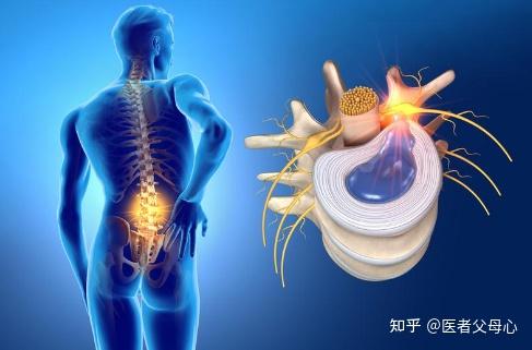 粘连;2,针具误伤硬膜外脉络丛形成硬膜外血肿,压迫马尾神经;3,麻醉剂
