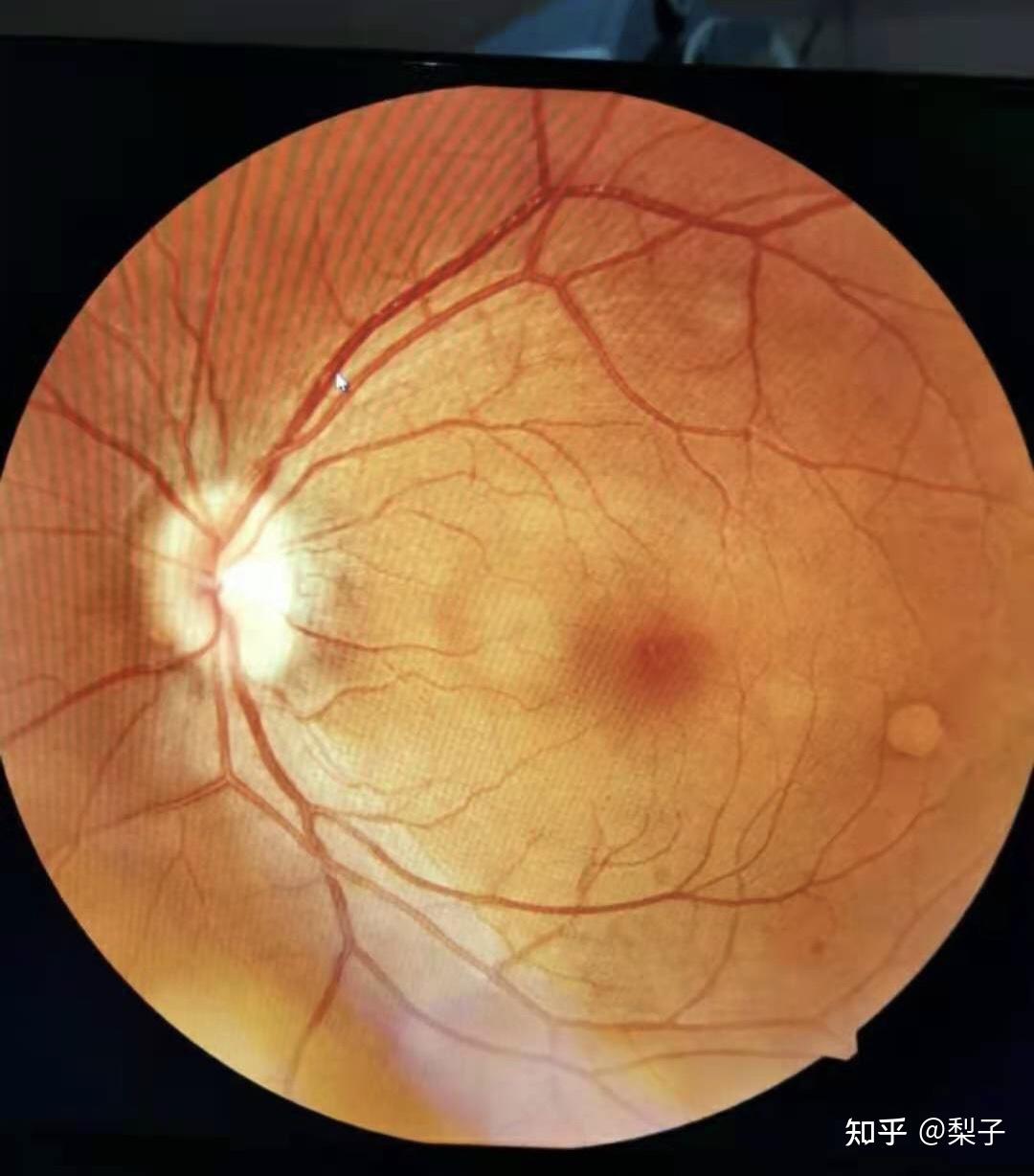 何为眼底检查 - 知乎