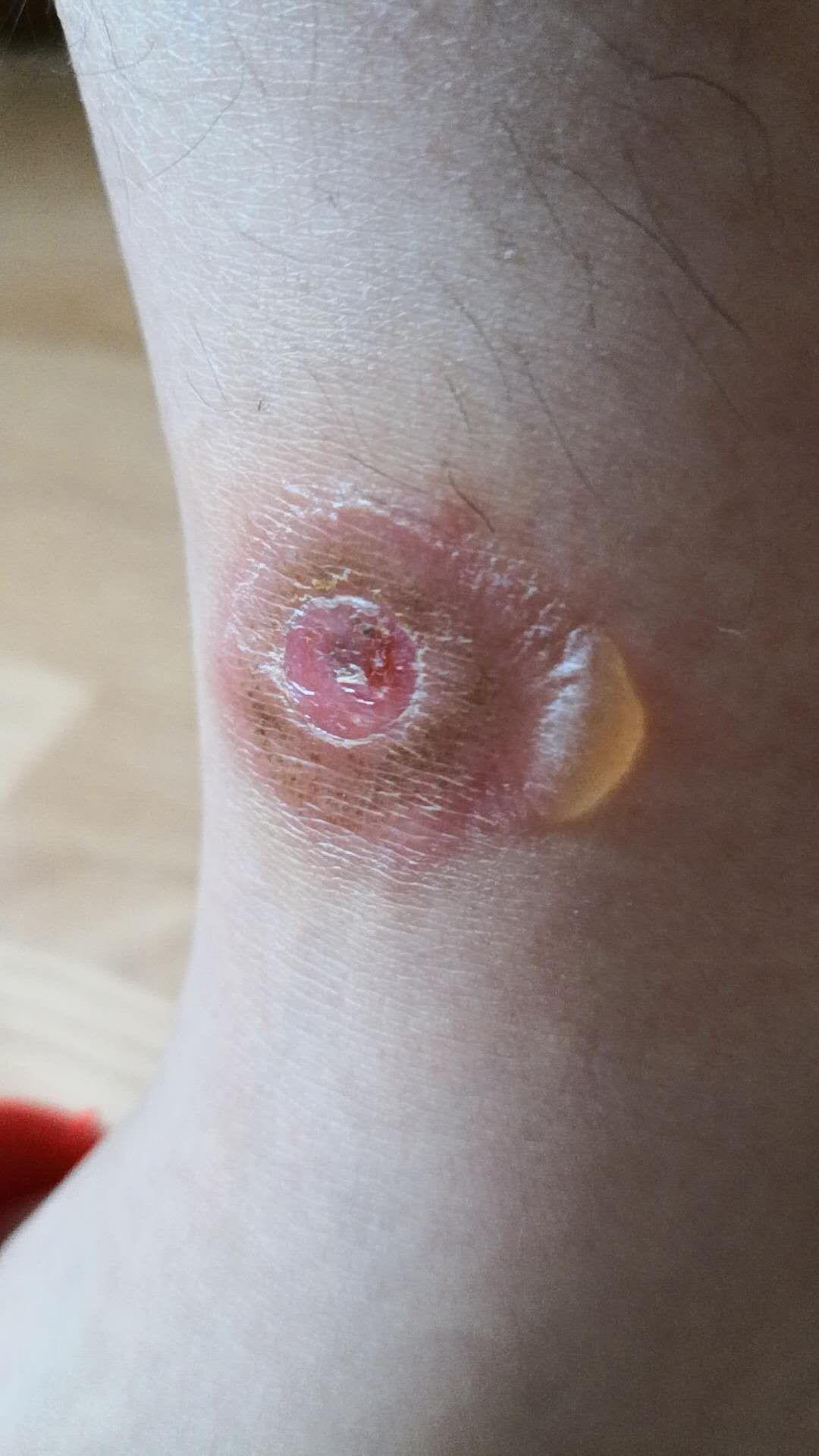 为什么被虫子咬的包会起水泡?