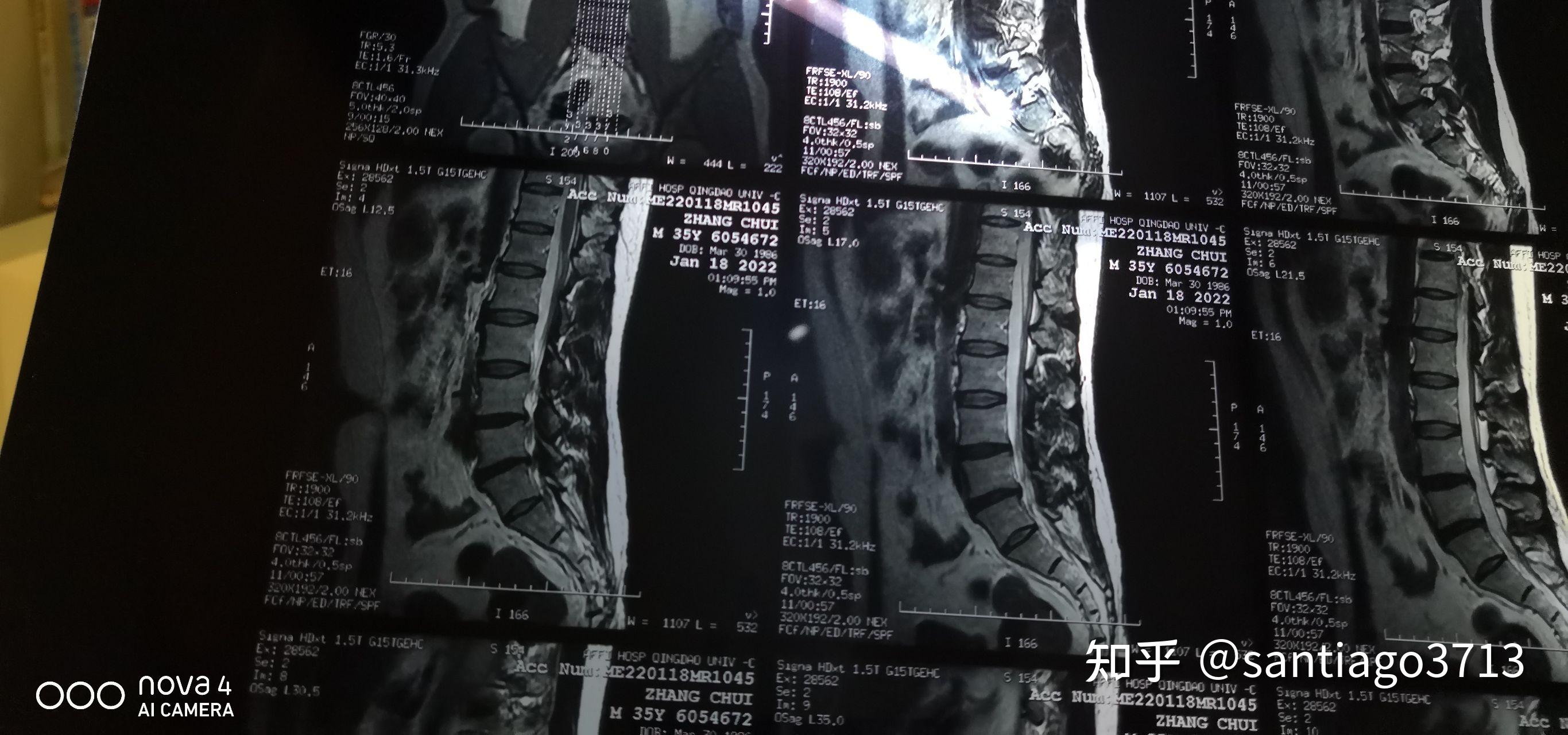 腰椎间盘突出微创手术及恢复过程 知乎 