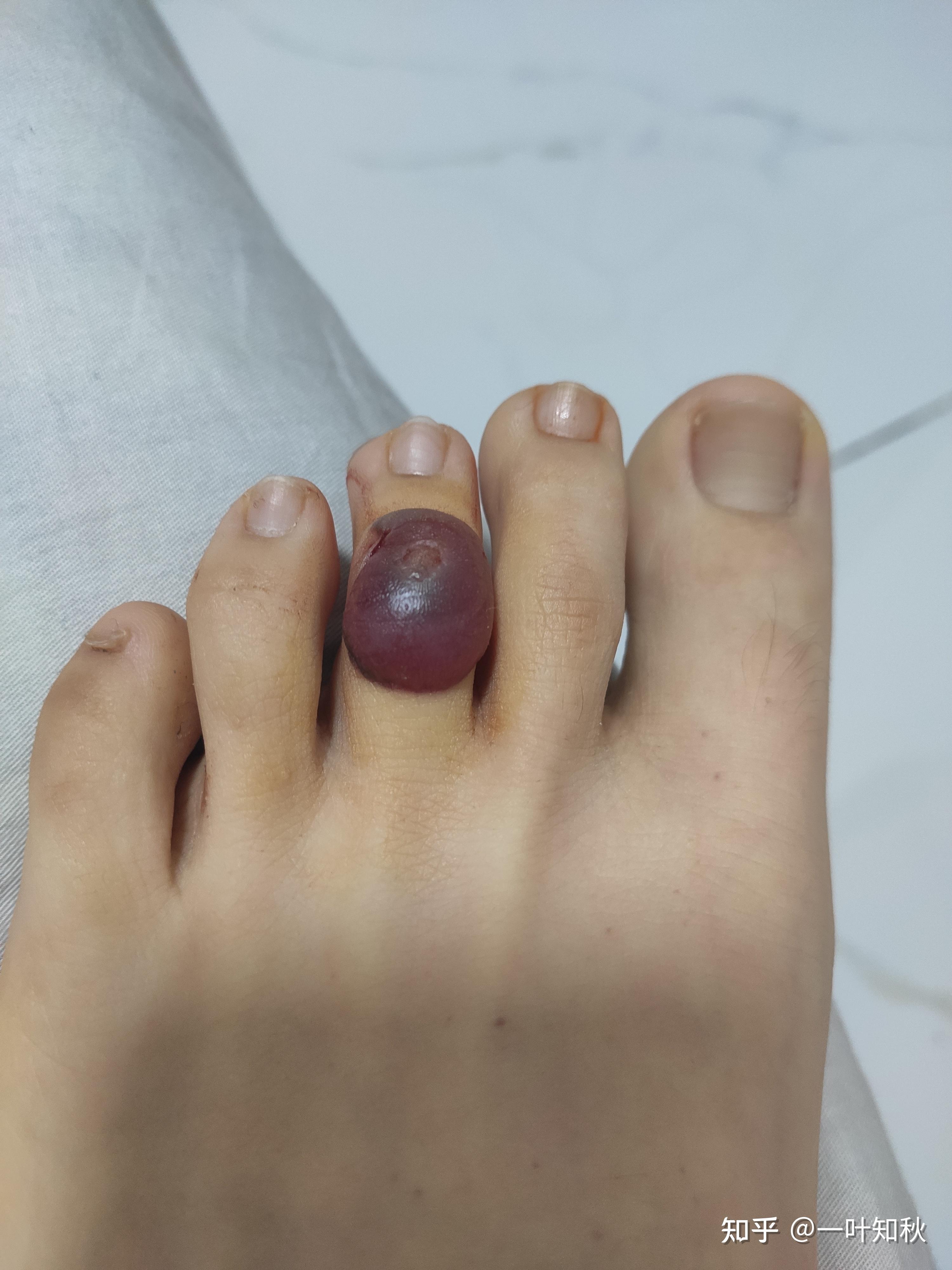 液氮冷冻治疗后手指上出了血泡而且越来越大该怎么办? - 知乎