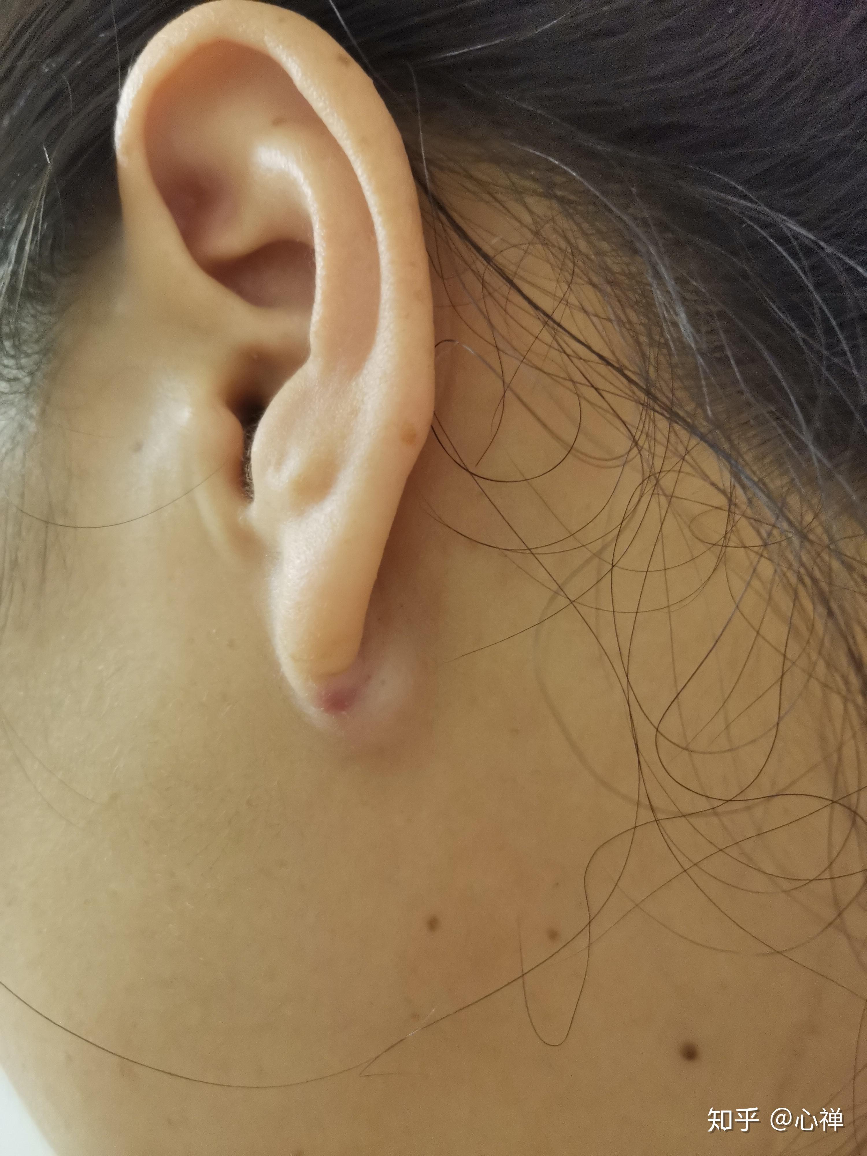 耳垂囊肿? - 知乎