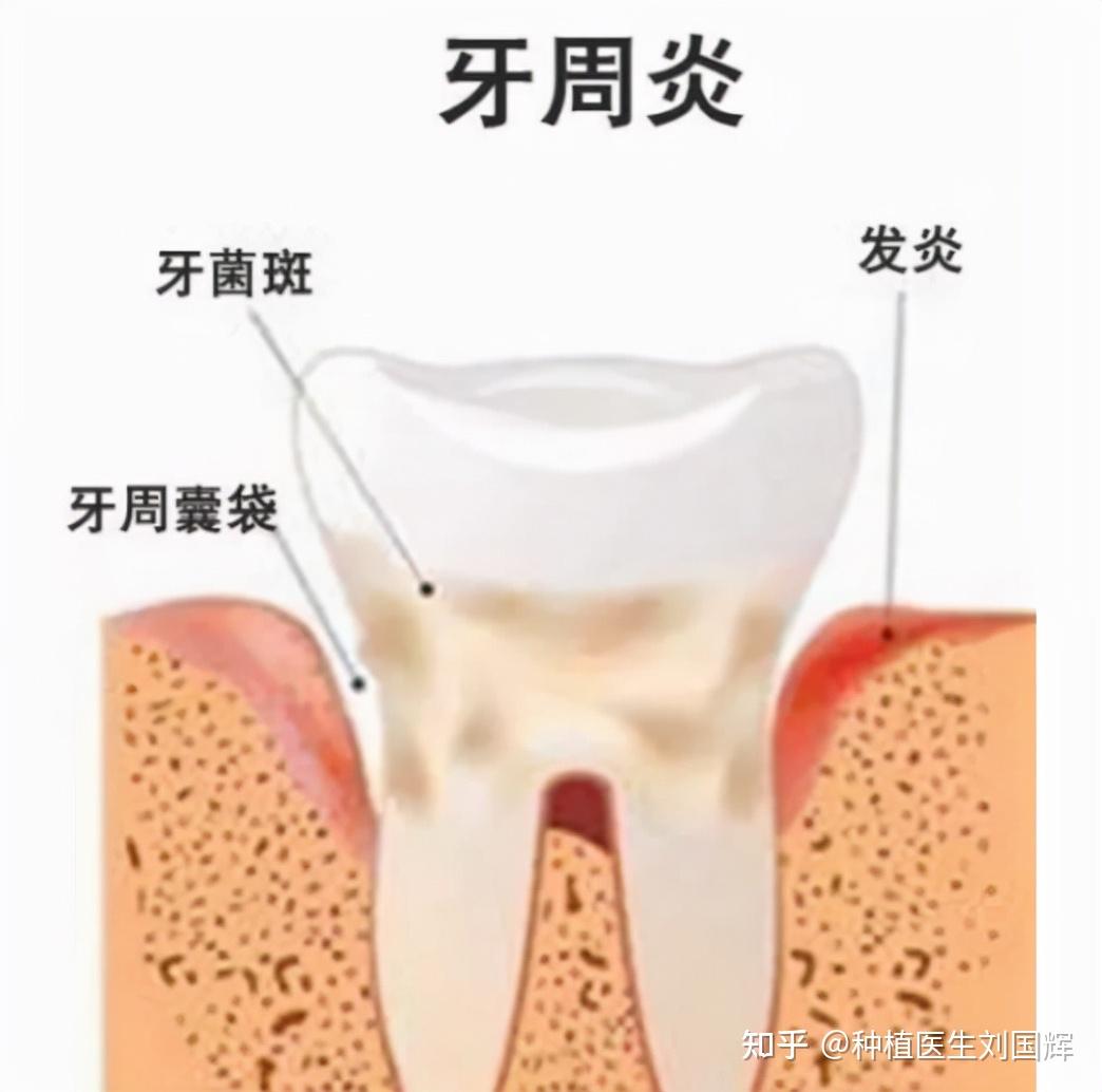 几个牙周炎的阶段要自知,以防牙齿全掉光! - 知乎