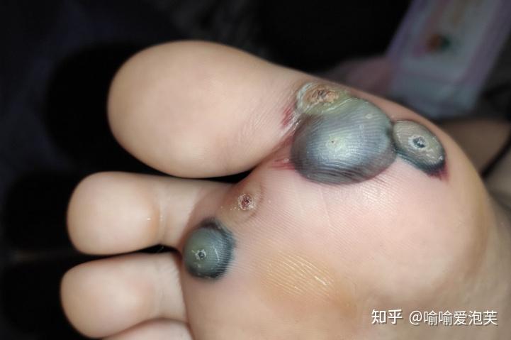 接触了跖疣后那香皂洗手能消毒吗会传染给手上吗