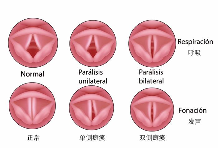 什么是声带闭合不良?