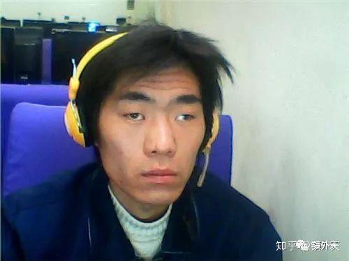 谈起斜视,很多人就想到了斗鸡眼.