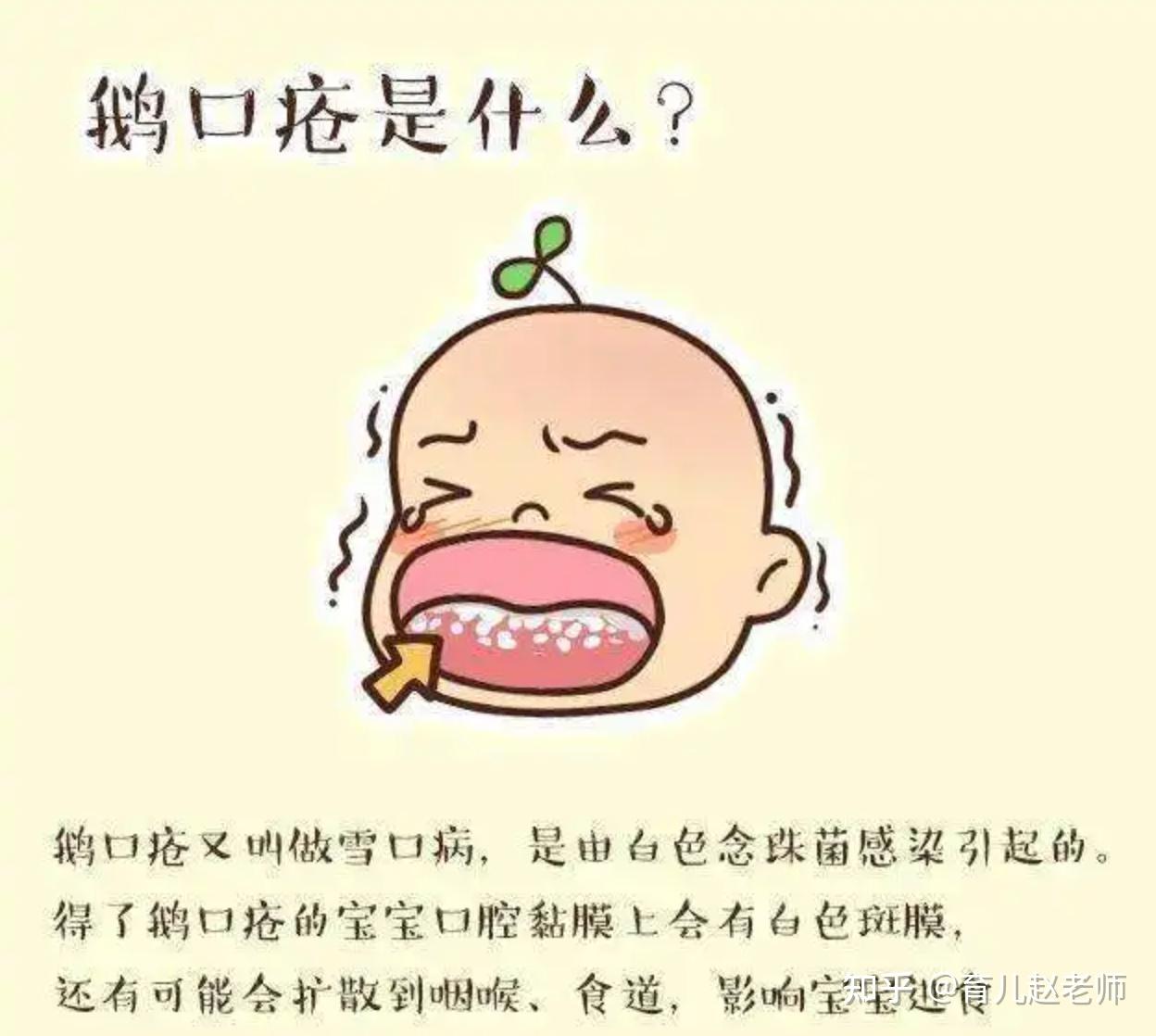 患儿口腔黏膜出现乳白色,微高起斑膜,形似奶块,周围无炎症反应,无痛.