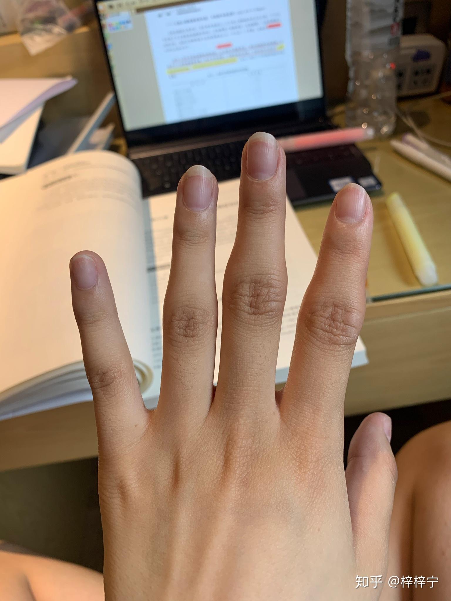 手指骨节大怎么办好像是当初不懂事按响造成的虽然很爽