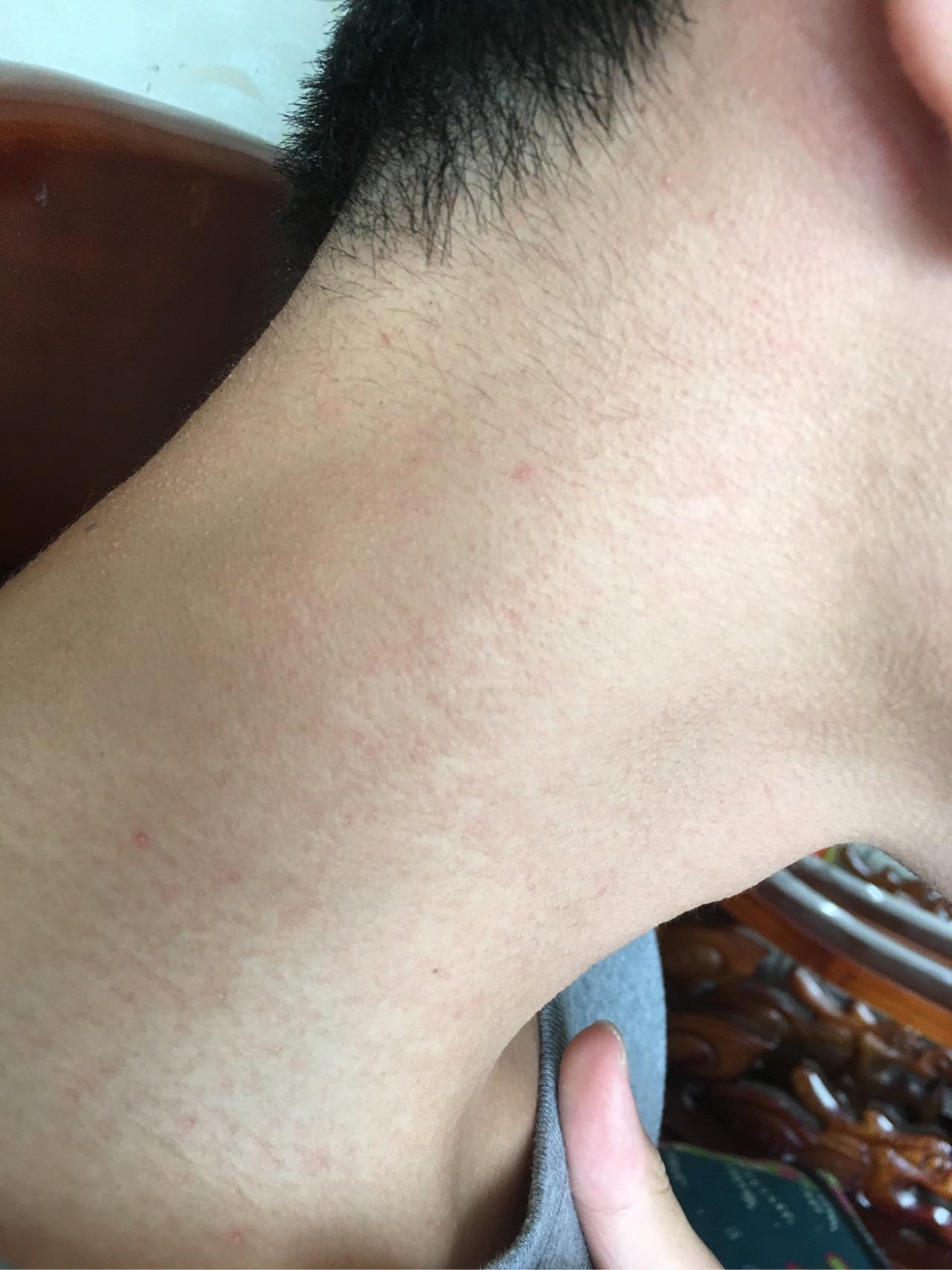 脸上出鸡皮疙瘩是怎么回事(脸上皮肤起鸡皮疙瘩怎么回事)