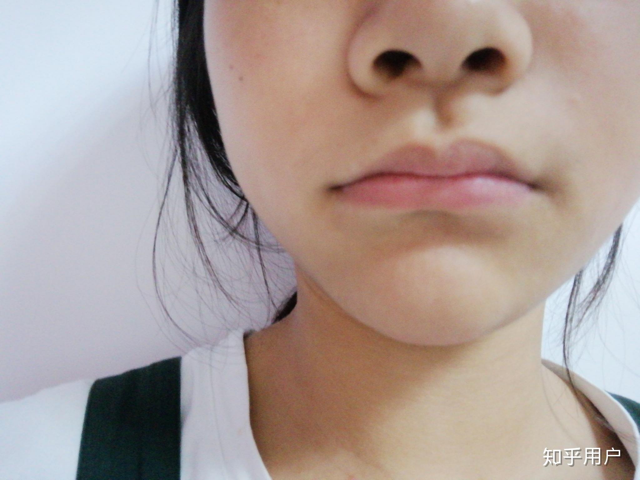 嘴角完全不对称要怎么矫正