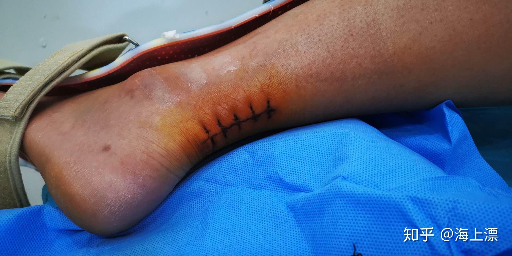 跟腱断裂手术及康复记录点滴进行中