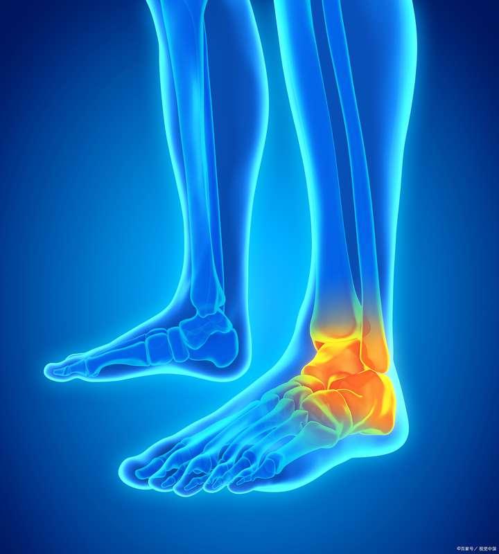 脚踝扭伤后何时开始康复锻炼? - 知乎