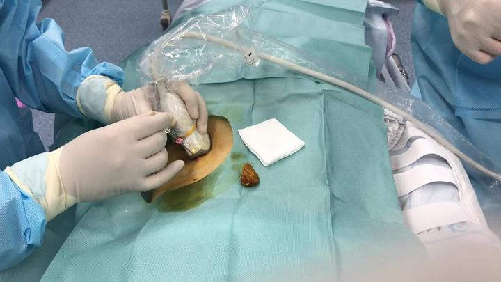 超声引导下徒手同轴肾穿刺活检术视频