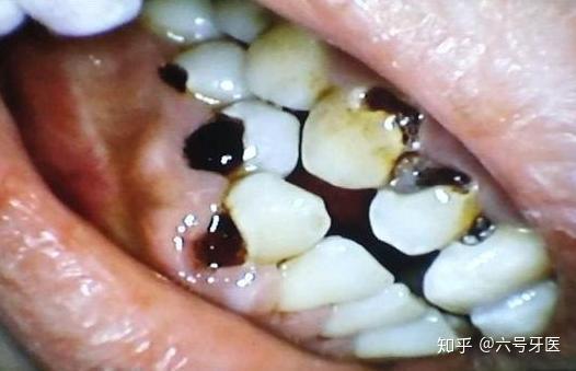 长期喝可乐对人的牙齿有何影响? 