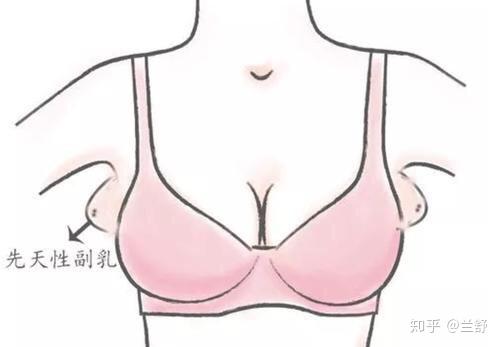 但在出生前仅保留胸前的一对,其他都退化了,不然便有可能出现多乳症