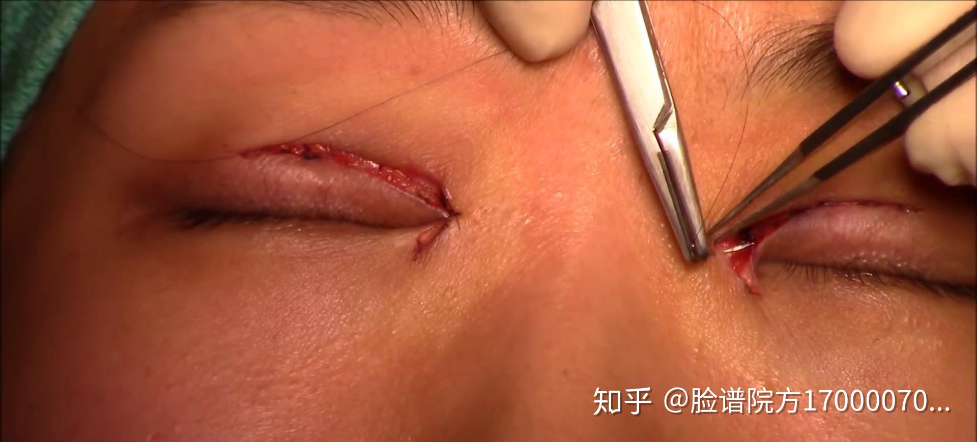 天然双眼皮和人工双眼皮别再傻傻分不清了