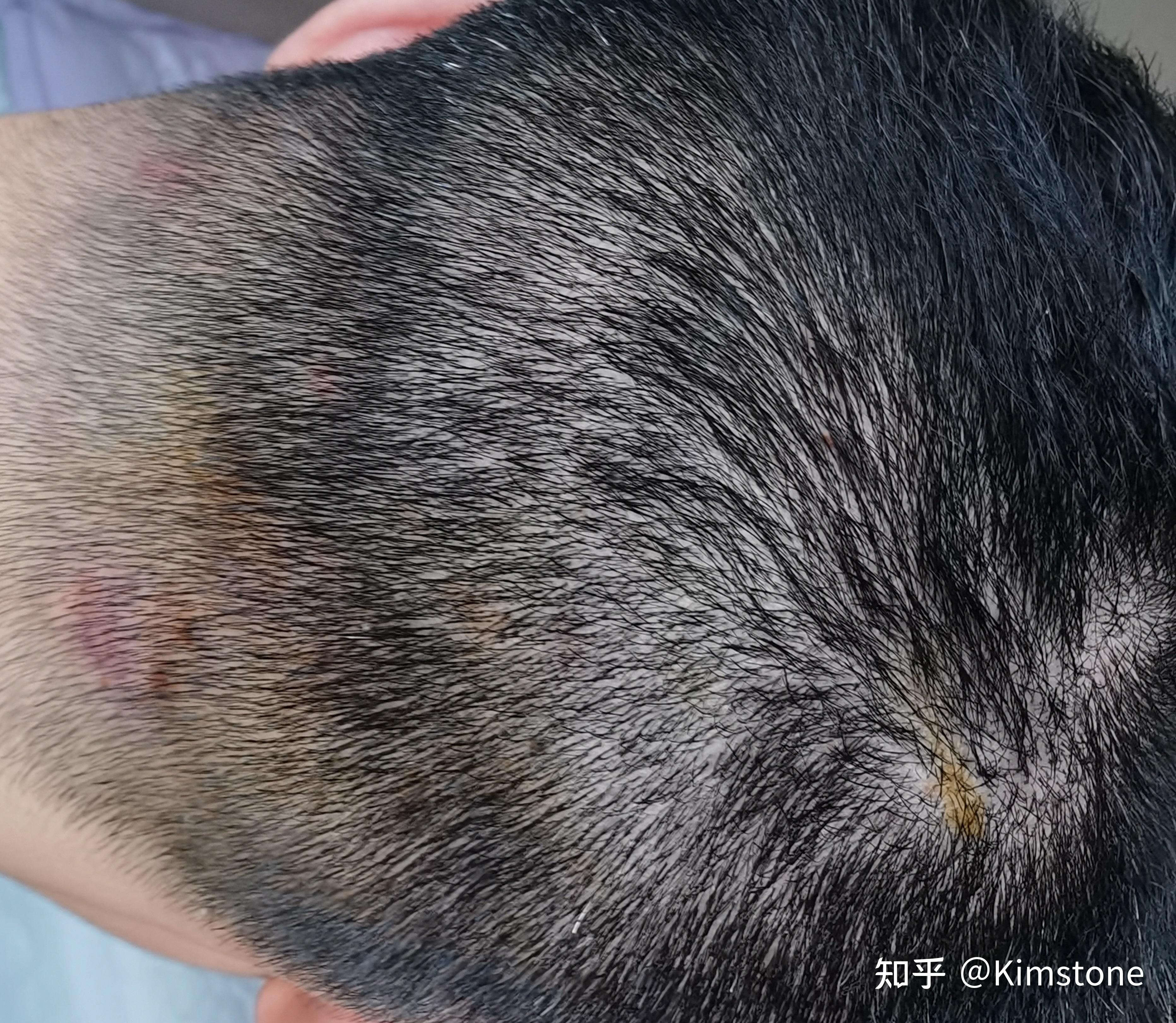 毛囊炎好的治疗方法? - 知乎