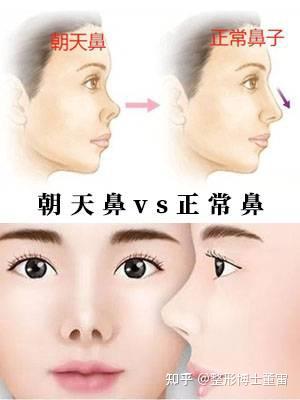 朝天鼻怎么形成的?又该如何矫正? - 知乎