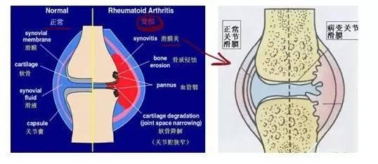 膝盖滑膜炎的中成药 v2-420f279e97edfa08fb9cb8f6400f0420_1440w.jpg?source=172ae18b