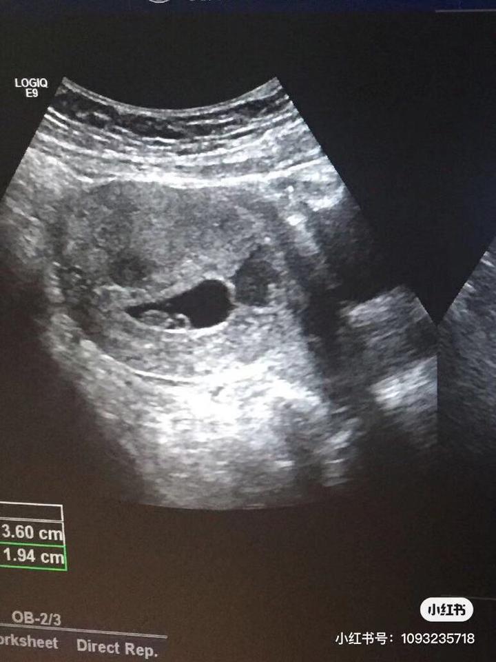 孕囊积液 绒毛膜血肿 保胎大咖治疗观点合集 知乎