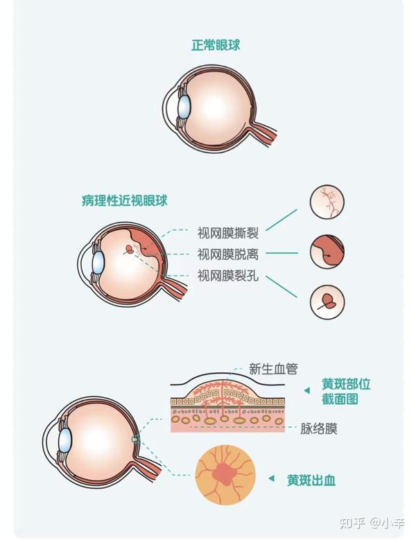 近视防控的重要性以及原理方法
