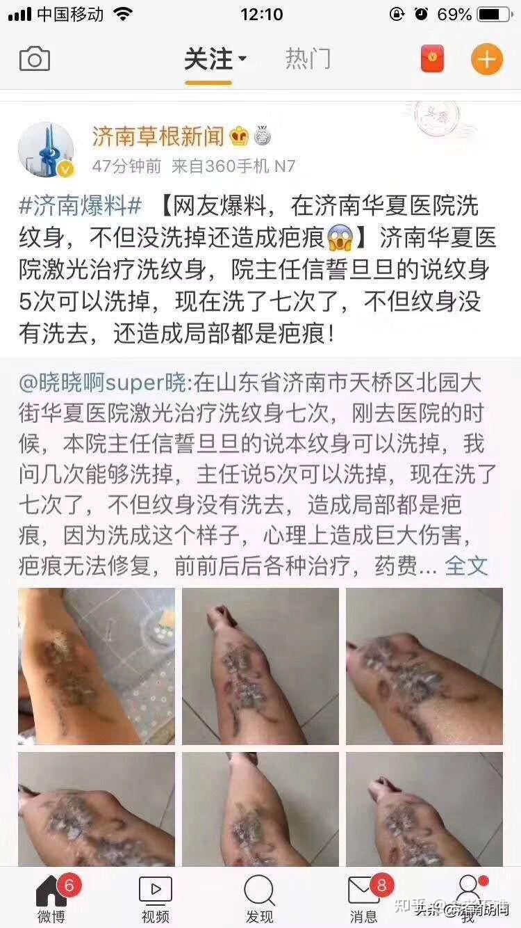 三甲医院洗纹身图片