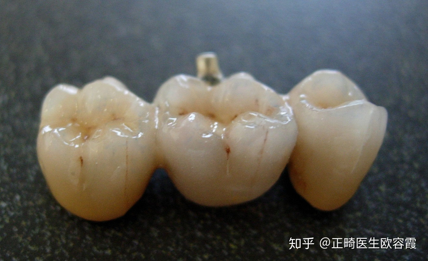 在深圳做烤瓷牙，如何判断烤瓷牙做得好不好？ - 知乎