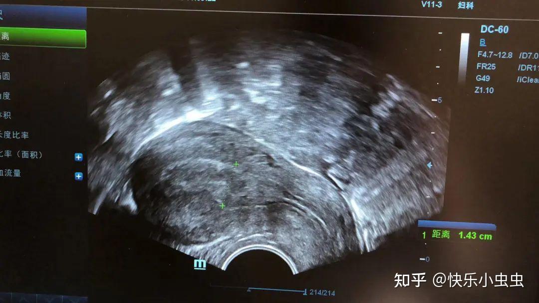什么样的子宫内膜是好的?B超片子告诉你! - 知乎
