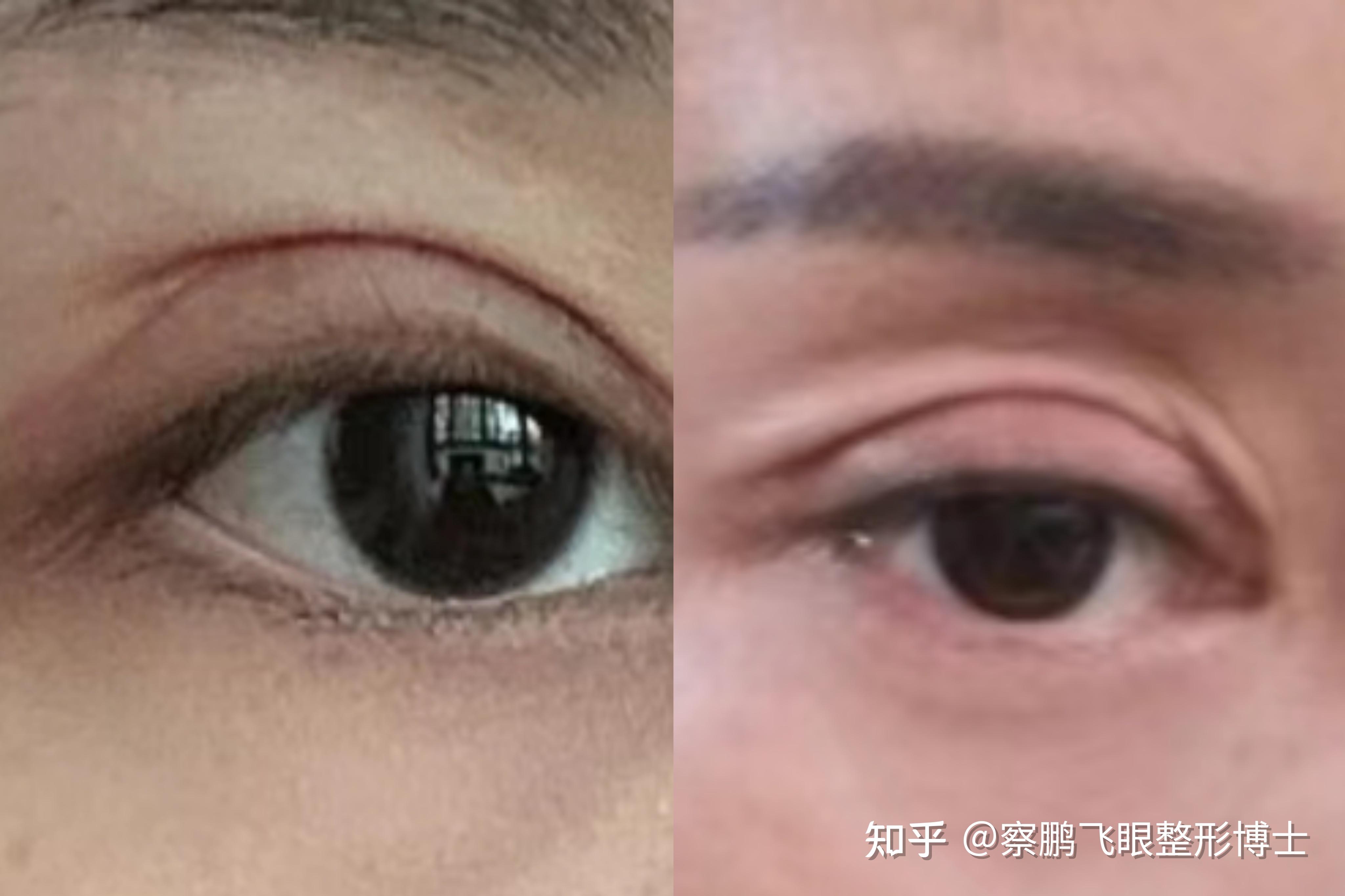 双眼皮（北京医院丁金萍）系列案例二 - 知乎