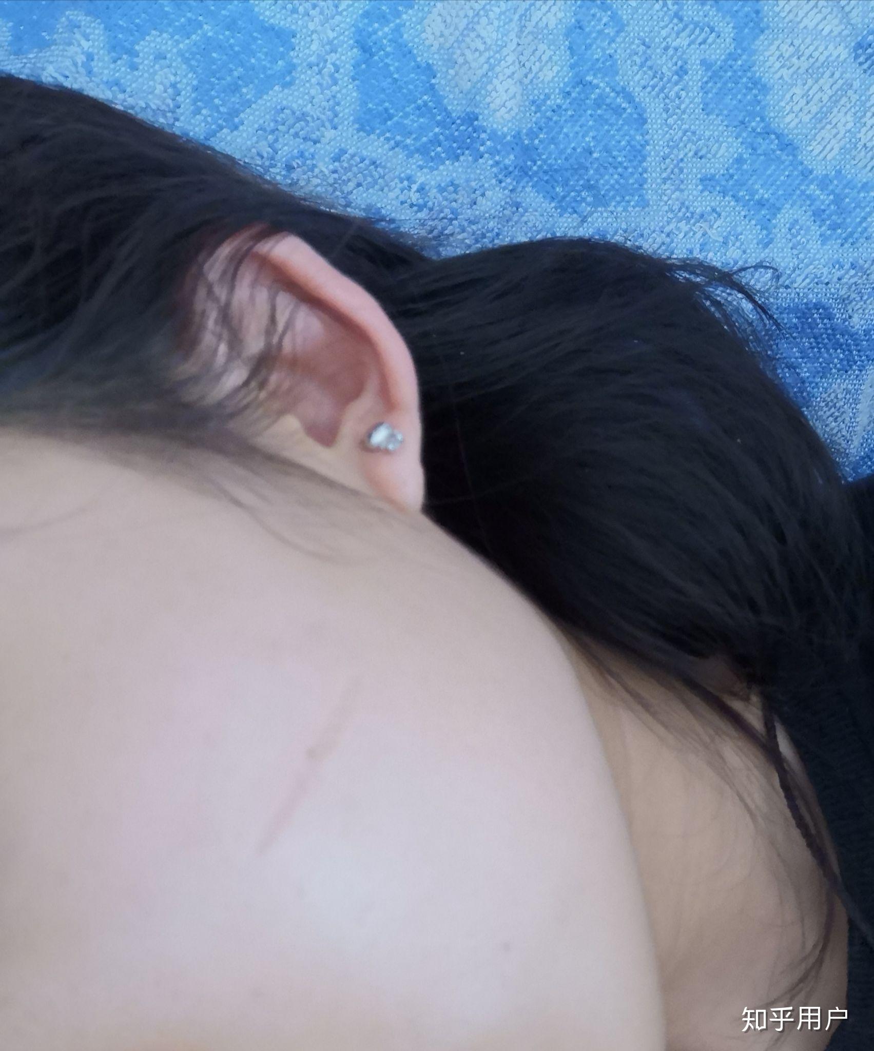 小时候打架脸上被抓了很多疤痕,可以怎么修复疤痕? - 知乎