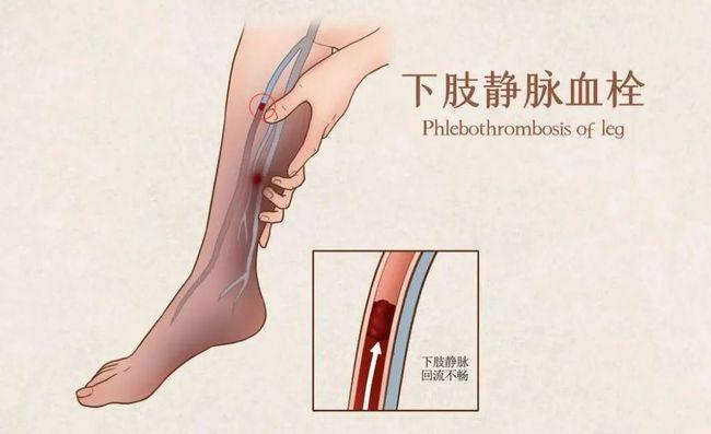 下肢靜脈血栓形成的原因及症狀