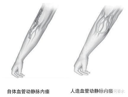 其餘部位可選擇左側頸內靜脈,雙側鎖骨下靜脈,雙側股靜脈