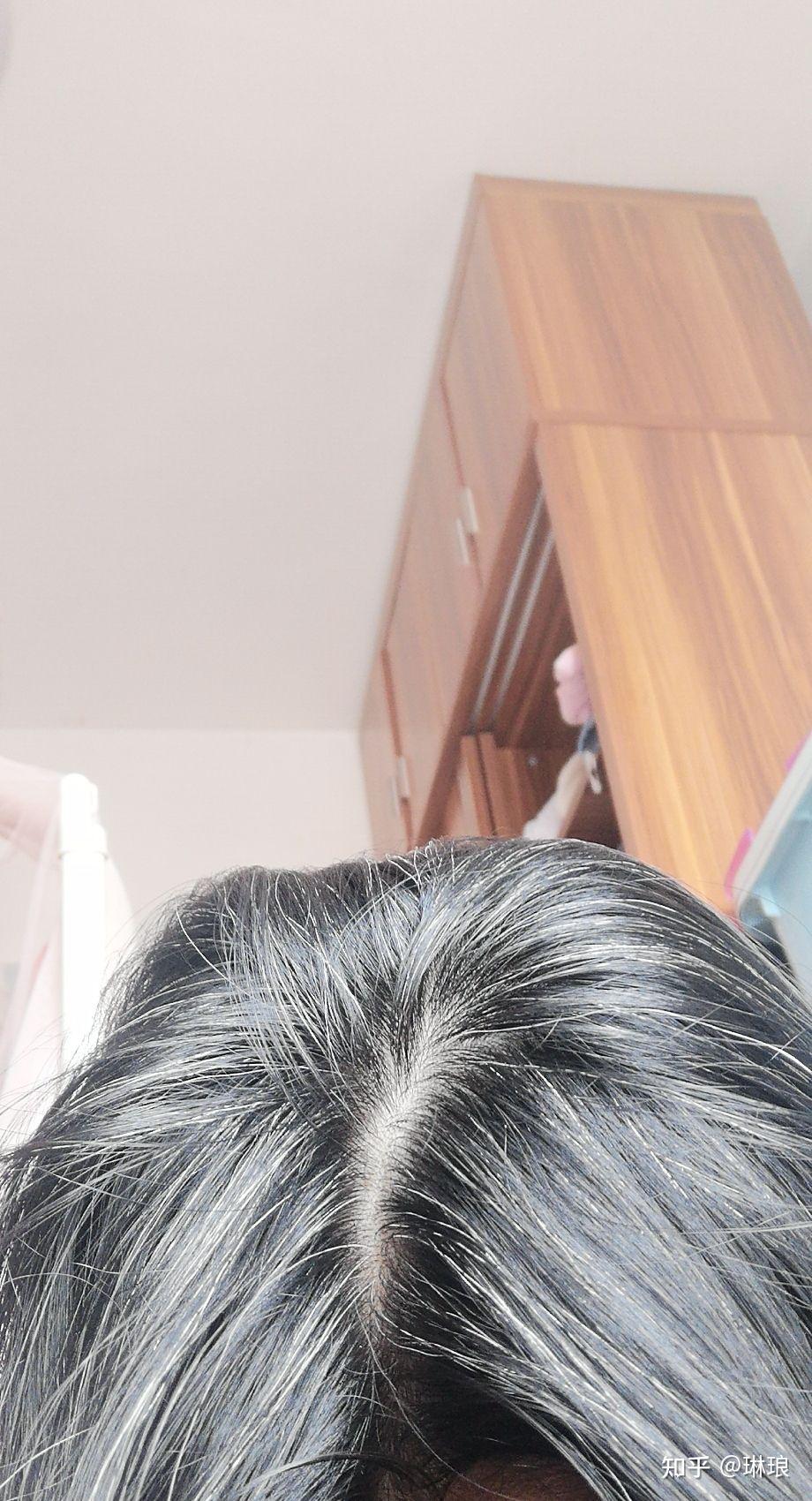 少年白头现在才21岁就满头白发了该怎么办