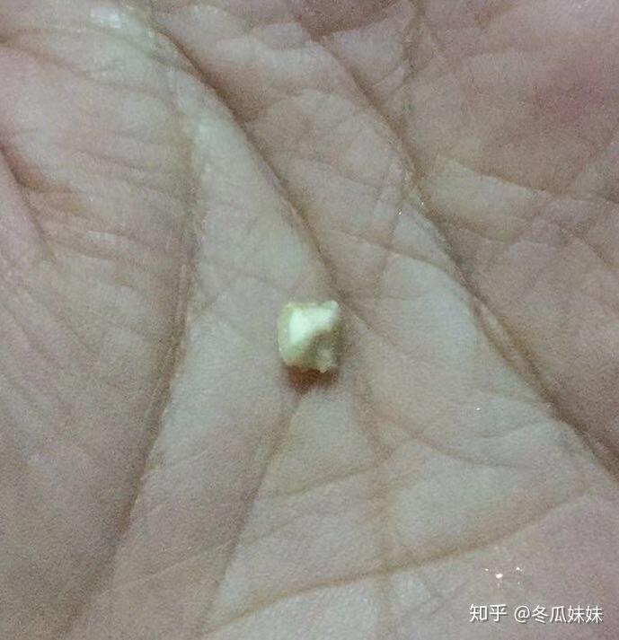 颌下腺结石要做手术吗