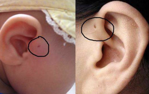 不开玩笑～据说,世界上不到 5% 的人,耳朵旁边天生会长一个小洞,有