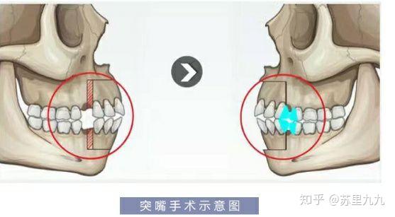 做牙套的原理_牙齿矫正的原理,原来牙套是这样移动的