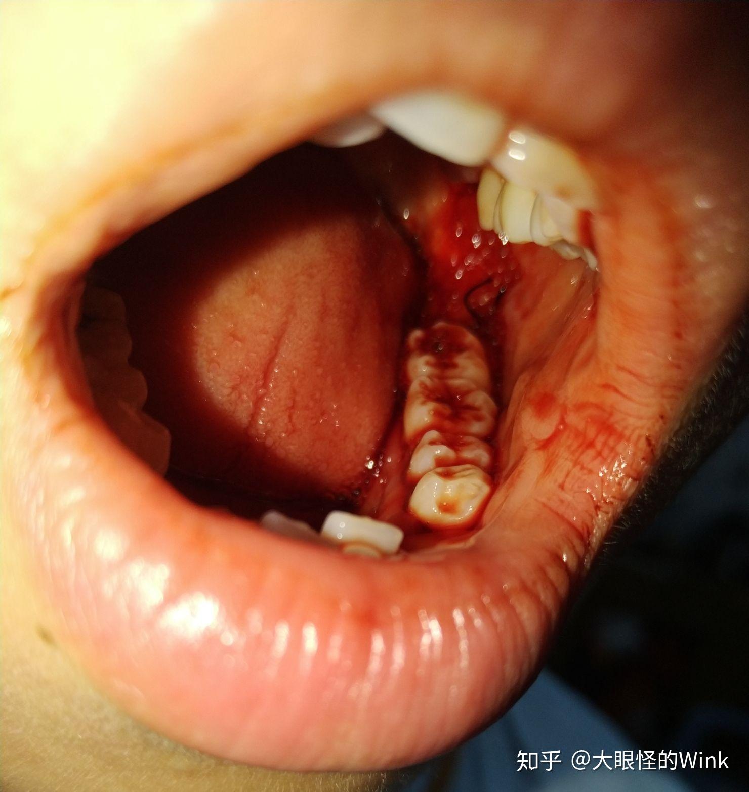 拔完智齿后那一周你经历了什么