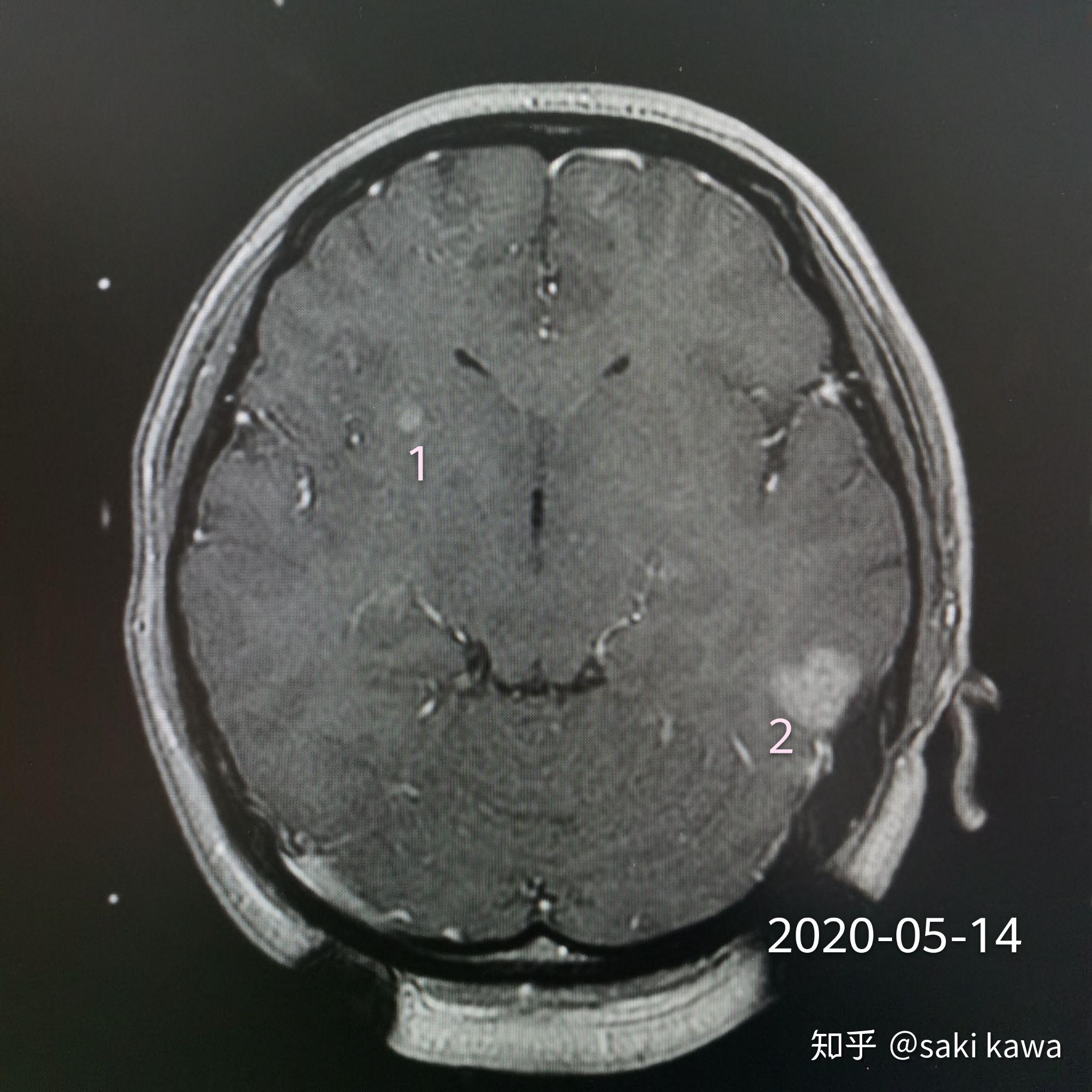 脑内多发转移瘤伽马刀治疗中的异质性