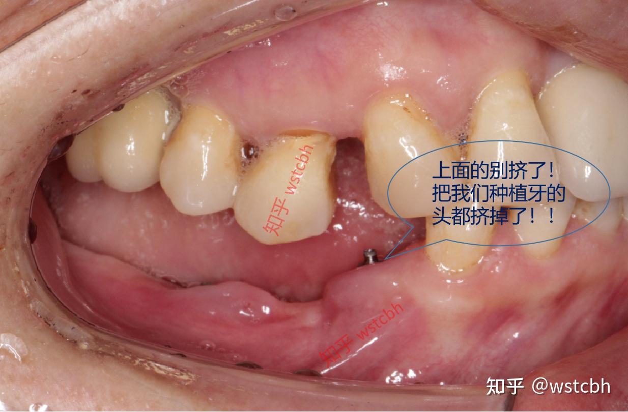 长期缺牙后对牙合牙伸长基本上是板上钉钉了,只是伸长多少的问题,我做