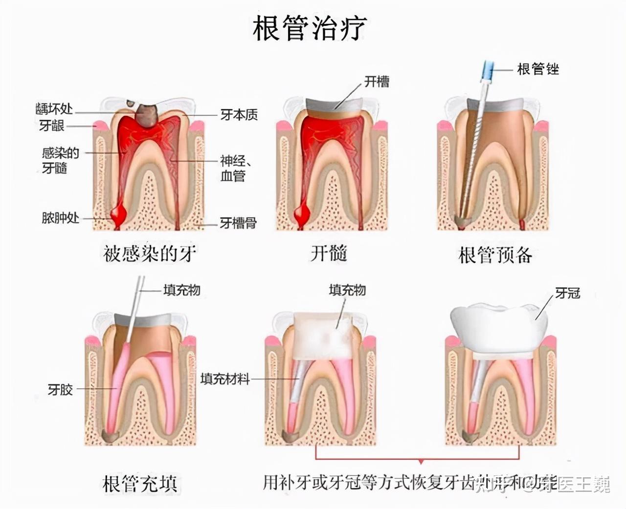 然而根據研究發現:約70%的牙周炎與牙周病是可以治療的,輕度的可以