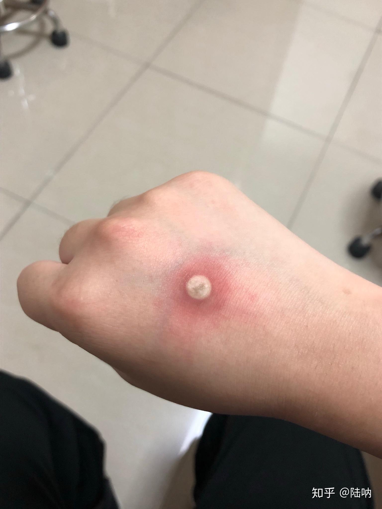 甲下寻常疣做液氮冷冻疼哭了可耐受疼痛真的这么厉害吗还是我太弱了