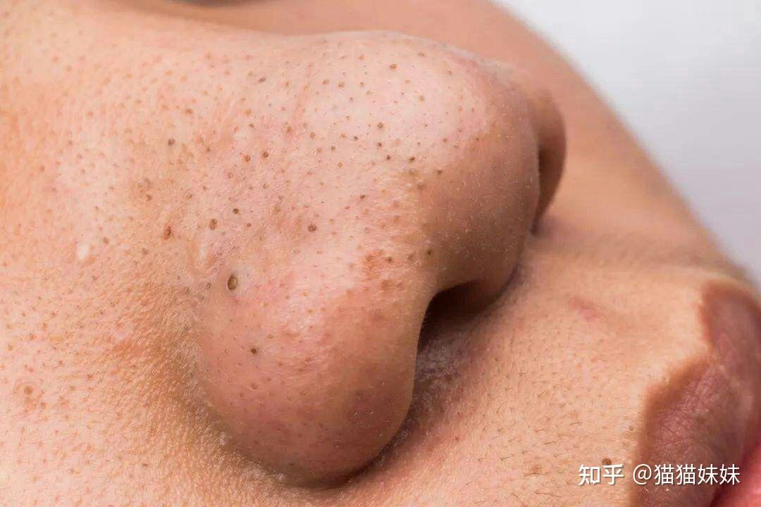为什么皮肤会长脂栓和黑头如何控制它们产生
