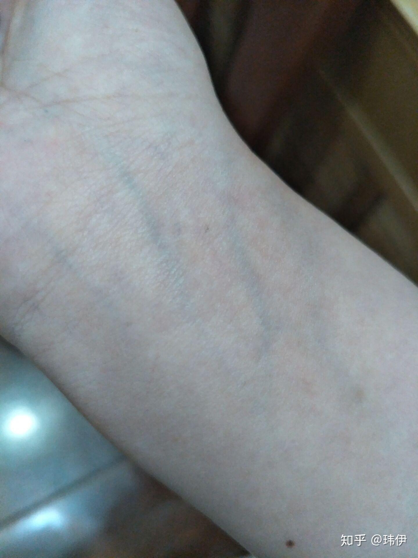 手腕上静脉颜色很明显,是身体有什么病症的原因吗?