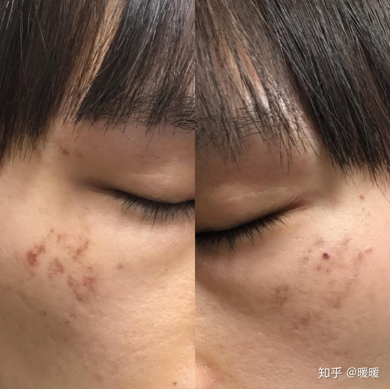 颧骨上长出来的斑是和身体的什么有关系? - 知乎