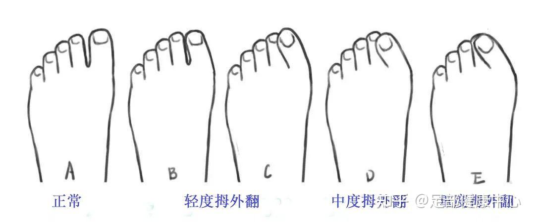 拇外翻角度测量方法图片